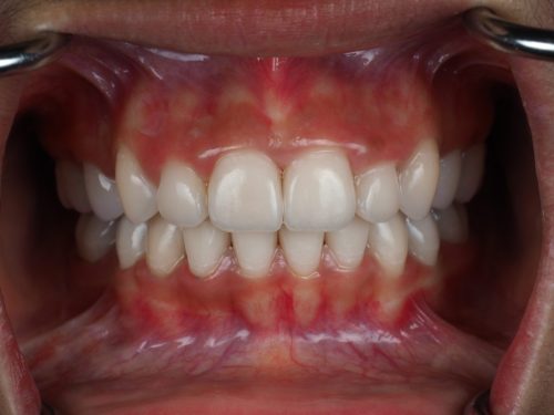 After e.Max Full Mouth Restoration 2