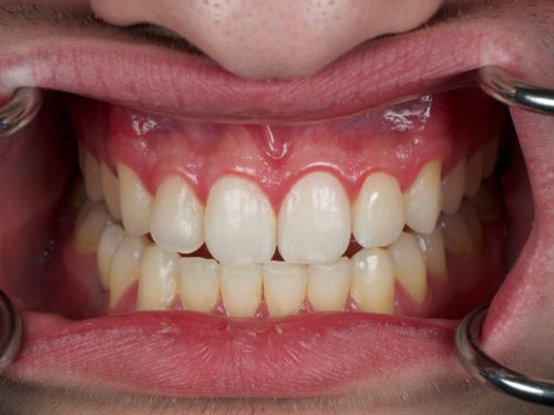 After Single Central Case 2