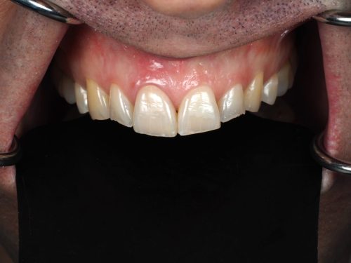 After Single Central Case 3