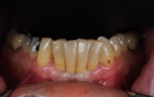 After Zirconia Implant Crown
