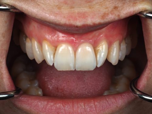 After Single Central Case 1
