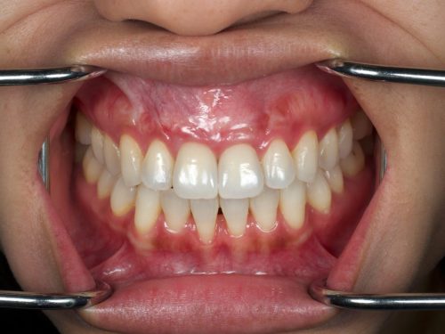 After Zirconia Two Central Crowns 2