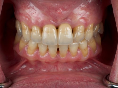 After Zirconia Two Central Implant Crown 1