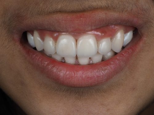 After e.Max Full Mouth Restoration 1