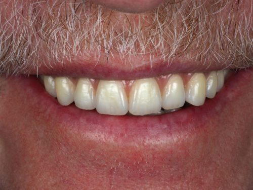 Full Arch Zirconia Implant Bridge with Gum After 2