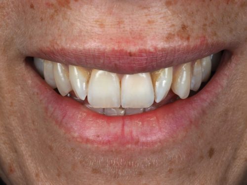 After Single Central Case 1