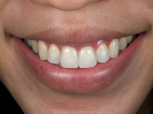After Zirconia Two Central Crowns 1