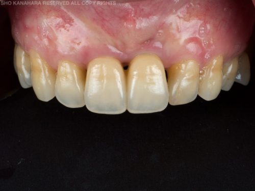 After Zirconia Two Central Implant Crown 2