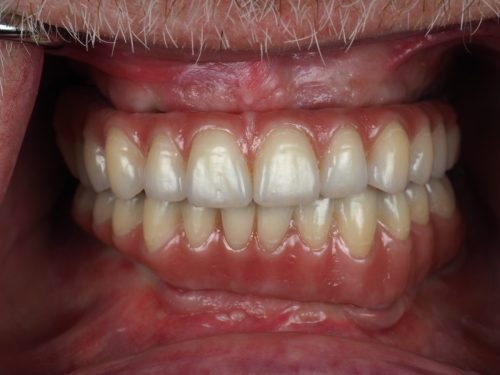 Full Arch Zirconia Implant Bridge with Gum After 1