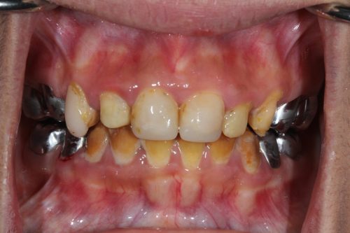 Before e.Max Full Mouth Restoration