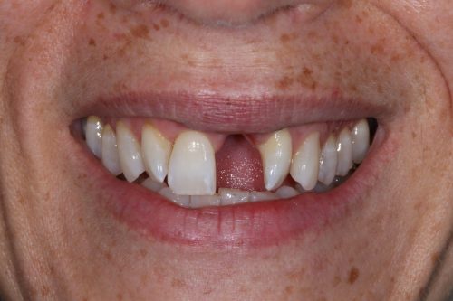 Before Single Central Case 1