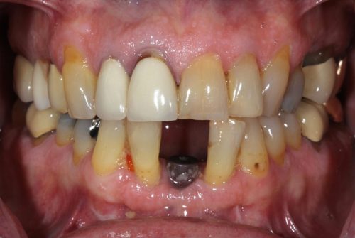 Before Zirconia Implant Crown