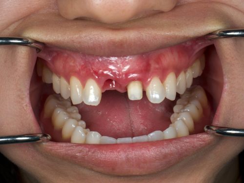 Before Zirconia Two Central Crowns
