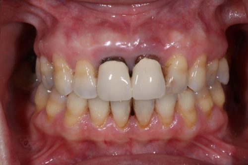 Before Zirconia Two Central Implant Crown